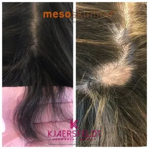 Meso hair system & scalp micro pigmentering
