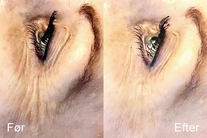 Øjenløft uden kirurgi