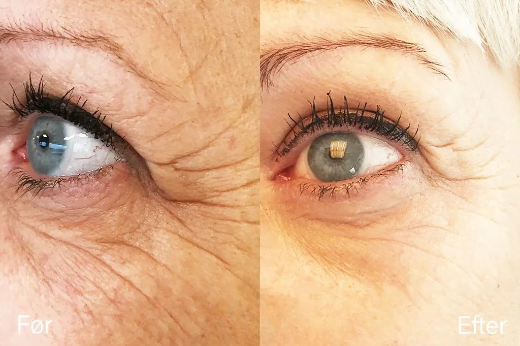 oejenloeft-botophase-img