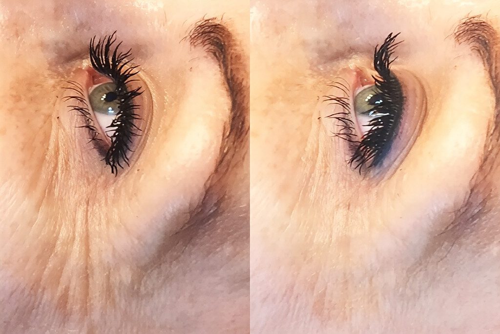 oejenloeft-uden-kirurgi