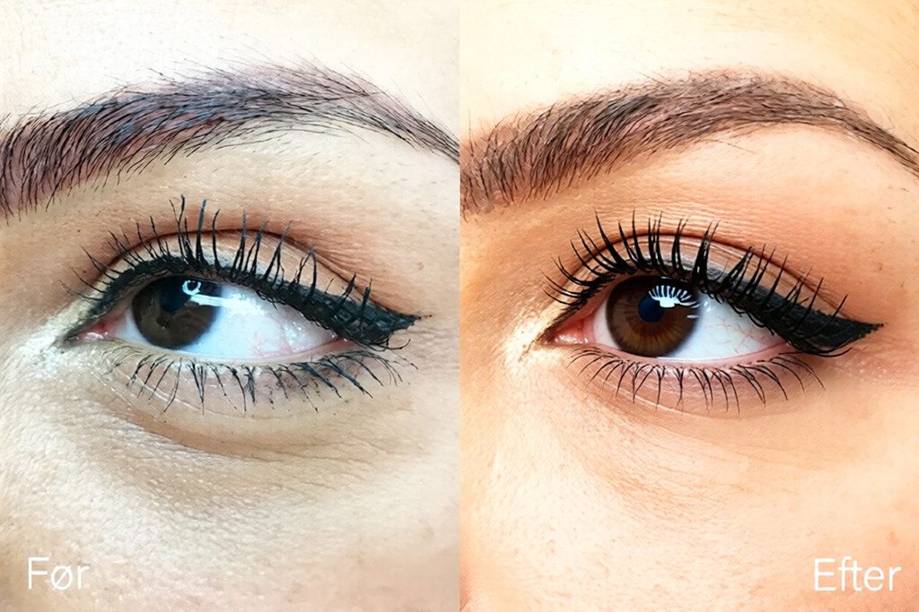 oejenloeft-uden-kirurgi