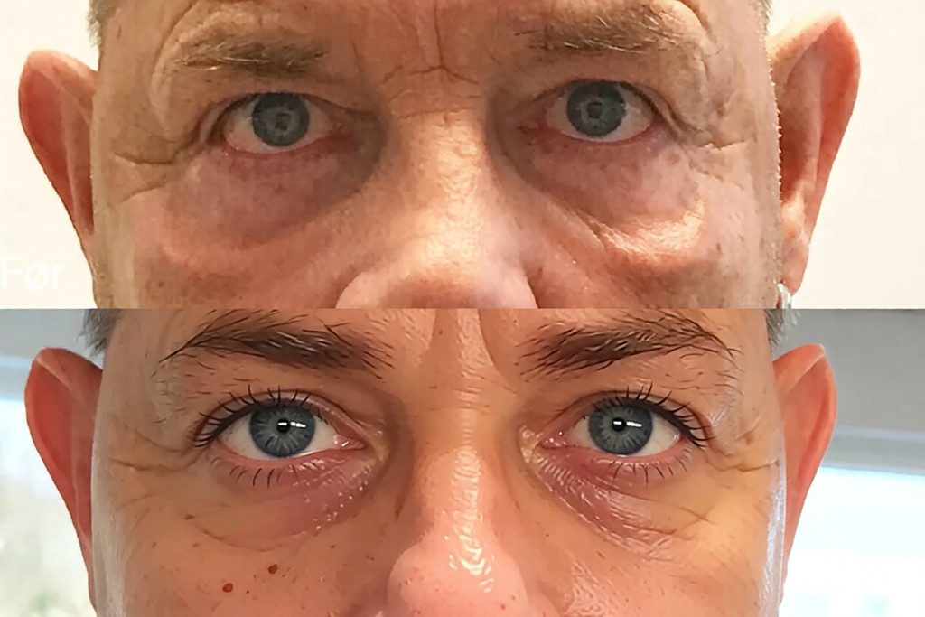 oejenloeft-uden-kirurgi