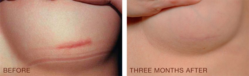 REOIL (30 mL) - Billede 2