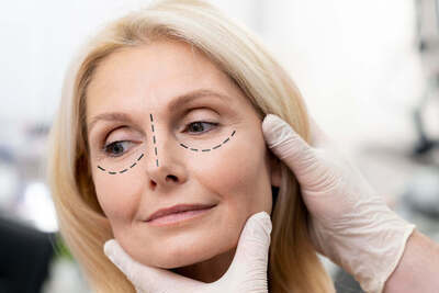 Øjenløft uden kirurgi