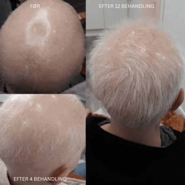 Før- og efterbilleder, der viser betydelig hårgenvækst og forbedret hovedbundsdækning efter hårtabsbehandling fra mesokinline.