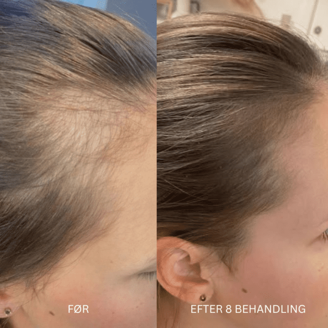Før- og efterbilleder, der illustrerer øget hårdensitet og fylde i en kvindes hår efter mesoterapibehandling - Hair loss control.