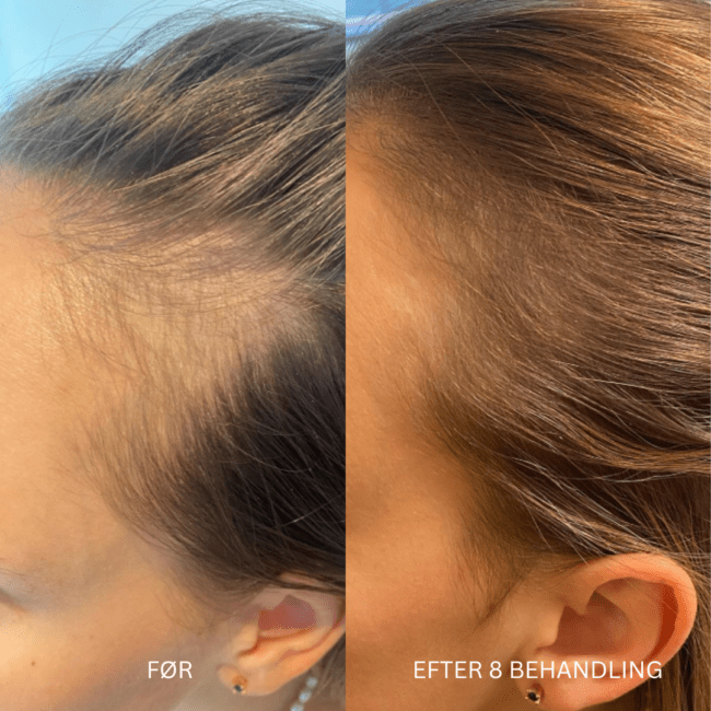 Sideprofil før- og efterbillede, der viser reduceret hårtab ved tindingerne efter hårrestaureringsbehandling.