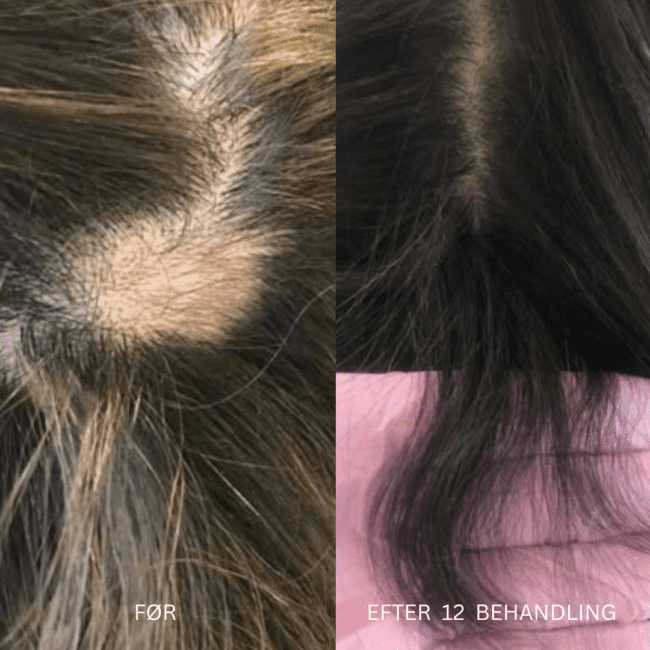 Før- og efterbilleder af en patients kroneområde, der viser synlig ny hårvækst og mindsket pletvis hårtab fra behandling.