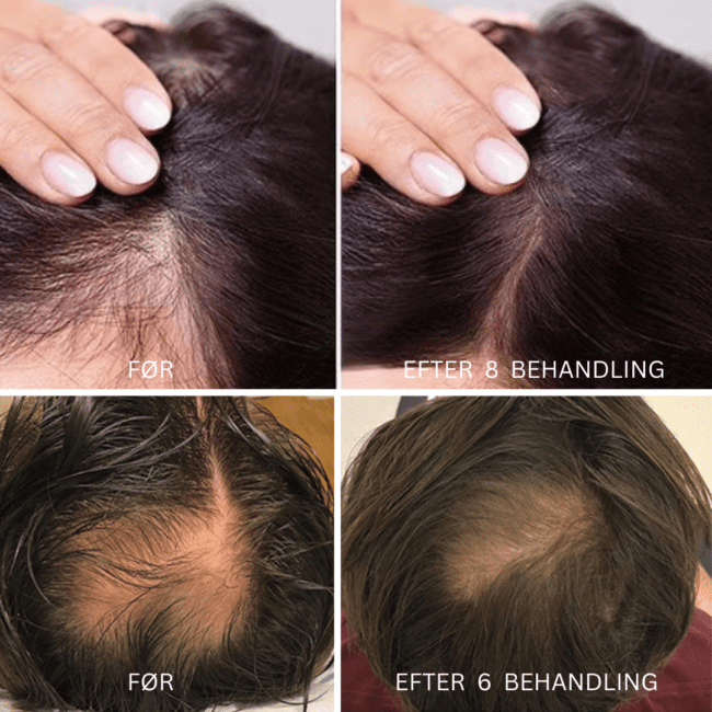 Ovenfra-og-ned-visning før- og efter sammenligning af resultater fra hårtabskontrolbehandling, der fremhæver forbedret densitet i hovedbunden.