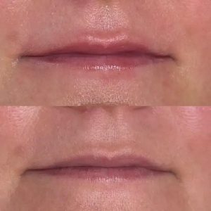 lips-meso-volume-img-1