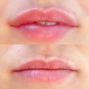 lips-meso-volume-img-2